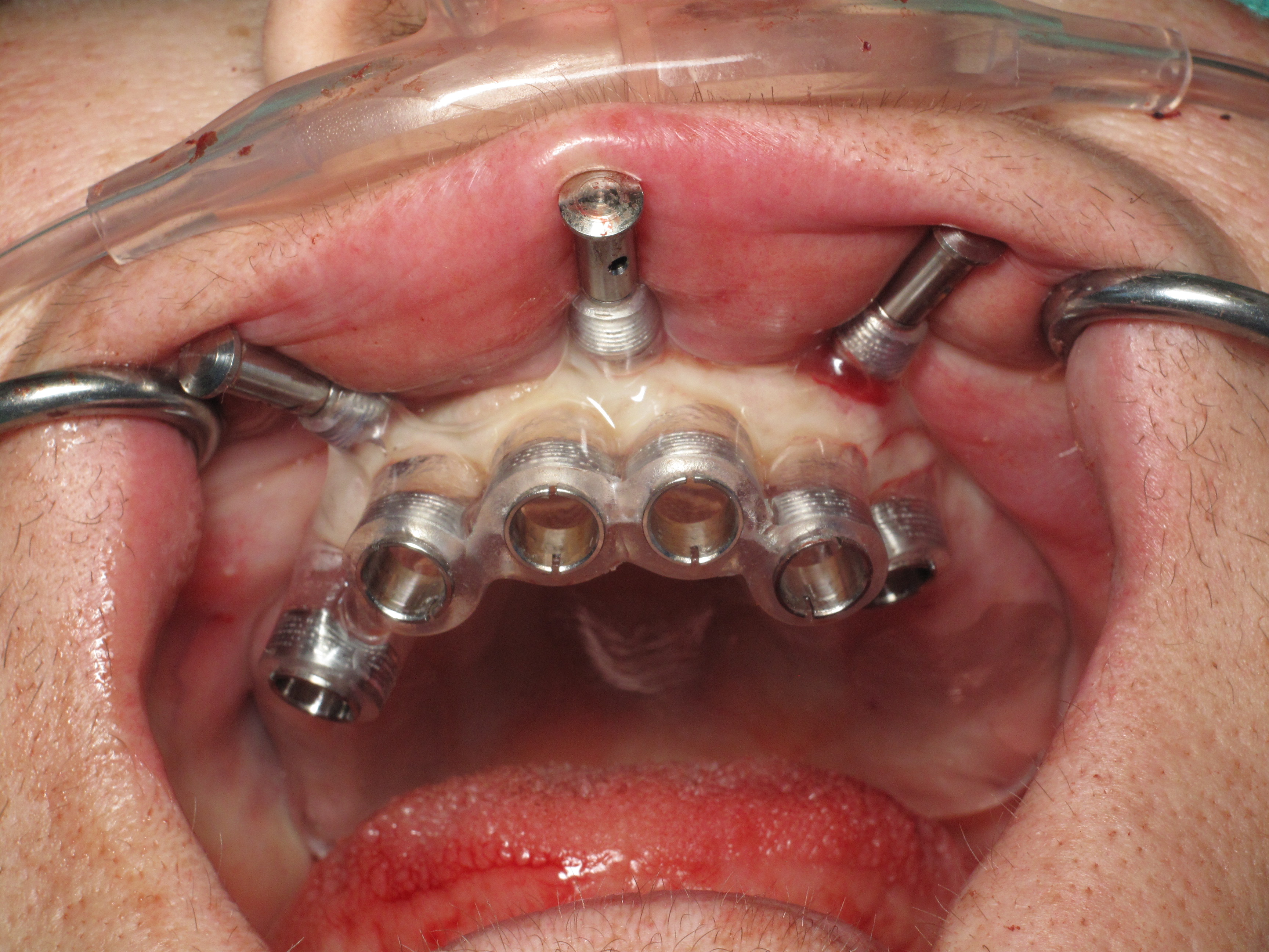 Dental implant treatment in Kolkata