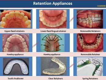 Retention appliances used Orthodontic treatment
